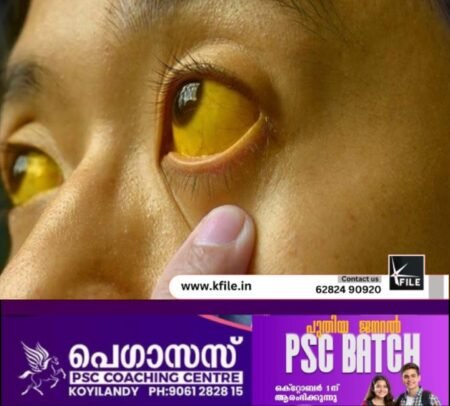 കുന്ദമംഗലം ഗ്രാമപഞ്ചായത്തിൽ മഞ്ഞപ്പിത്തം വ്യാപകം