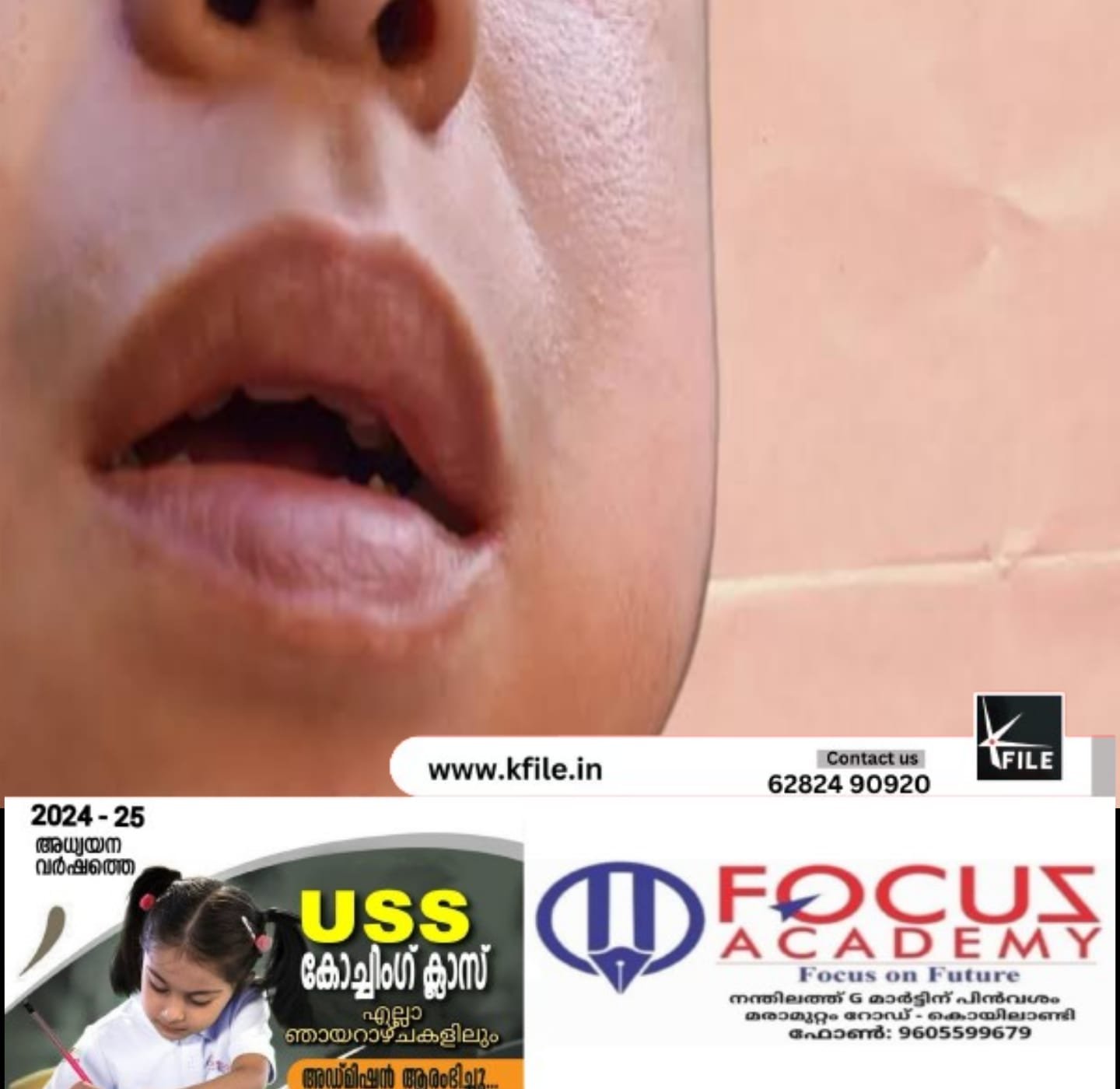 സംസ്ഥാനത്തെ സ്കൂൾ വിദ്യാർത്ഥികളിൽ മുണ്ടിനീര് വ്യാപിക്കുന്നു സംസ്ഥാനത്തെ സ്കൂൾ വിദ്യാർത്ഥികളിൽ മുണ്ടിനീര് വ്യാപിക്കുന്നു