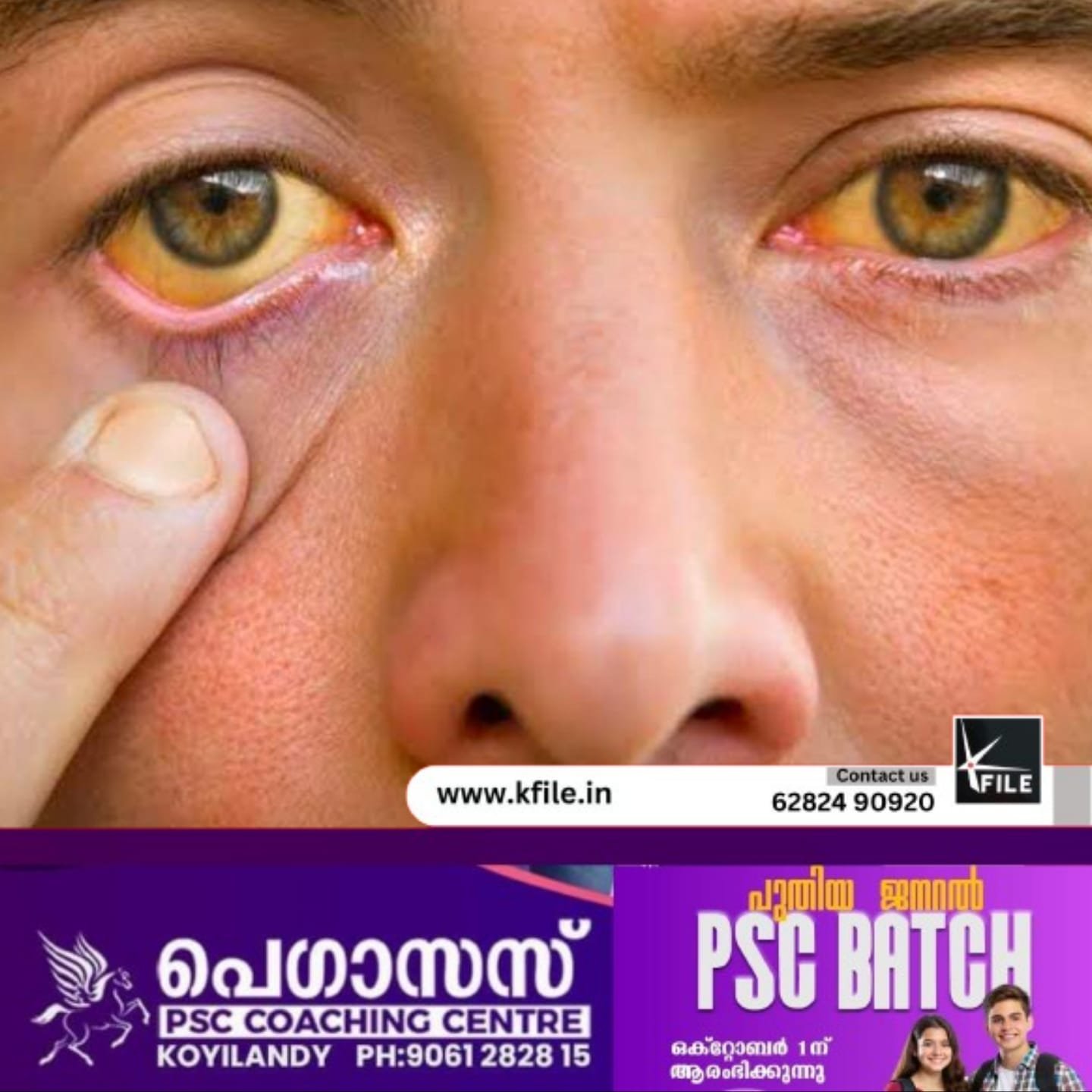 10 പേർക്കു കൂടി മഞ്ഞപ്പിത്തം സ്ഥിരീകരിച്ചു 10 പേർക്കു കൂടി മഞ്ഞപ്പിത്തം സ്ഥിരീകരിച്ചു