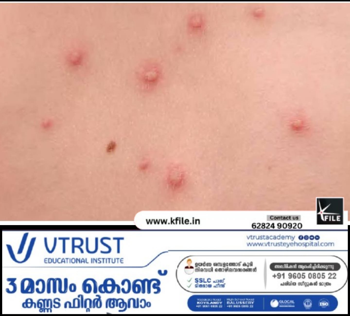 എറണാകുളത്ത് ചിക്കുൻഗുനിയ വ്യാപനം ഒമ്പത് പേർക്ക് സ്ഥിരീകരിച്ചു , ജാഗ്രതാ നിർദേശം എറണാകുളത്ത് ചിക്കുൻഗുനിയ വ്യാപനം ഒമ്പത് പേർക്ക് സ്ഥിരീകരിച്ചു , ജാഗ്രതാ നിർദേശം